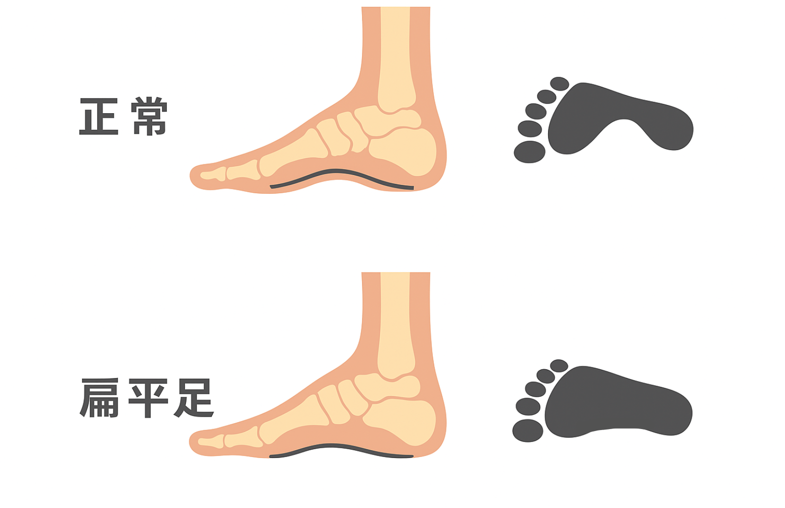 偏平足イラスト